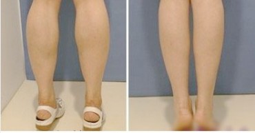 注射瘦小腿培训