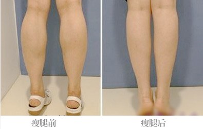 注射瘦小腿培训