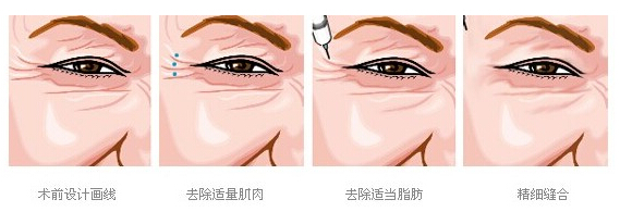 最爱微整形项目