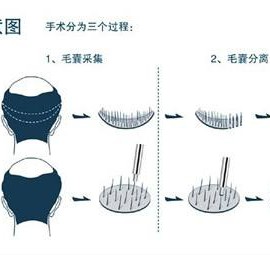 毛发移植培训