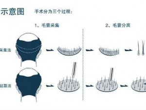 毛发移植培训